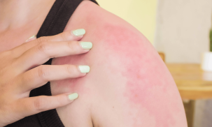 Blog - Pós-Carnaval: exposição solar sem proteção adequada aumenta casos de danos à pele e acende alerta para câncer